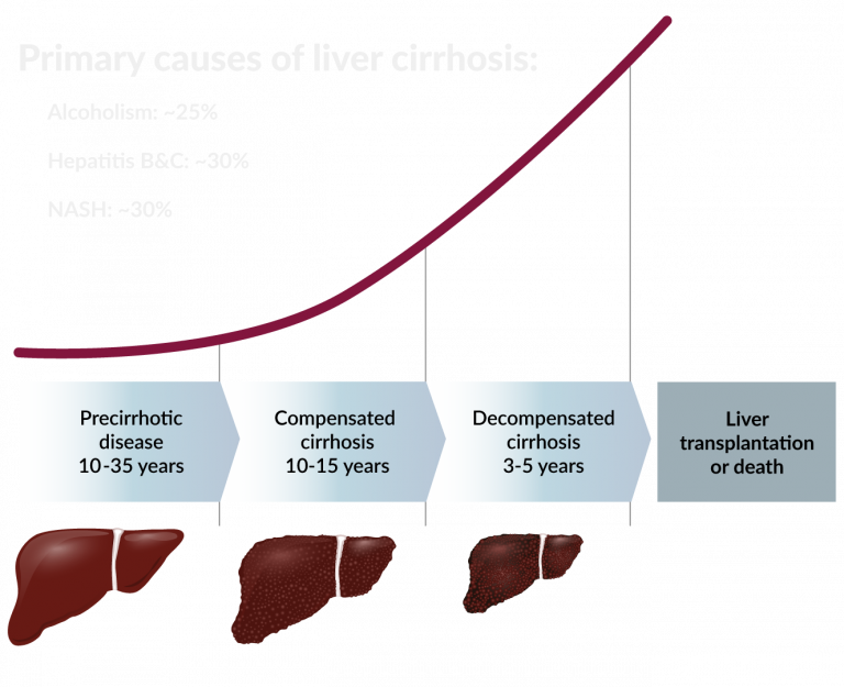Primary Causes of Liver Cirrhosis